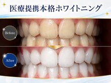 メルヴェイユ/本格医療提携ホワイトニング