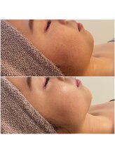 ミュレア 新宿本店(mulea)/【4D4000shot +ラジオ波】