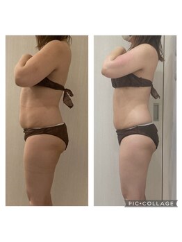 クリスタル(CRYSTAL)/◆【セル脂肪撃退】上半身コース