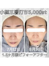 ハロ 南青山(HALO)/小顔3層打ち☆5,000shot