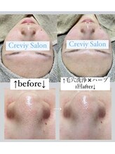 クレヴィー(Creviy)/韓国式3D毛穴洗浄×ハーブ1回