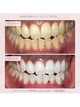 エクシアホワイトニング 札幌中島公園店/Before After［ホワイトニング］