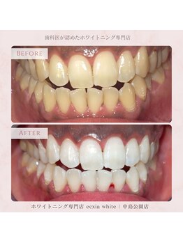 エクシアホワイトニング 札幌中島公園店/Before After［ホワイトニング］