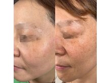 ケイビューティーセンター(K beauty center)の雰囲気（毛穴／毛穴洗浄/シミ改善／シワ改善／ニキビケア／美白）
