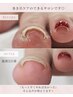 【巻き爪ケア+フットワンカラー】導入価格！親指2本巻き爪ケア♪
