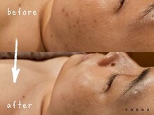 ボウ 静岡本店(VOEUX)/フェイスラインニキビ　3回