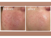 アリィ(Alii)/赤みのあるお肌をしっかり鎮静