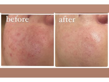 アリィ(Alii)/赤みのあるお肌をしっかり鎮静