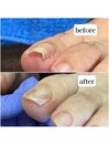 巻き爪ケア