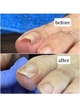 TonaLino by ルカポン/巻き爪ケア