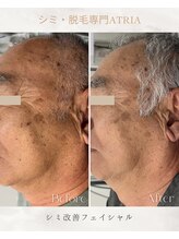 アトリア(ATRIA)/シミ改善フェイシャル