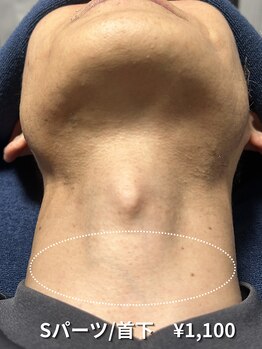 カナウ(KANAU)/【Sパーツ/脱毛】首下