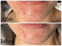 ジェミニ フェイス デザイン(Gemini Face Design)/REVI陶肌トリートメント