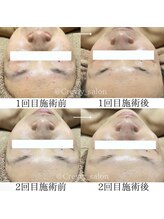 クレヴィー(Creviy)/陶肌トリートメント2回の変化