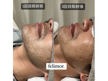 フェリモール(Felimor.)/メンズ光脱毛