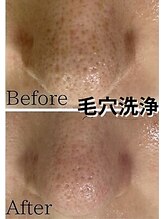 アルゴ 八幡黒崎店(ALGO)/毛穴洗浄