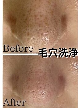 アルゴ 八幡黒崎店(ALGO)/毛穴洗浄