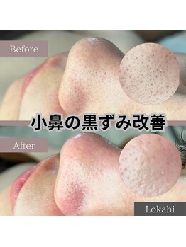ロカヒ(Lokahi)/鼻の皮脂詰まり毛穴洗浄