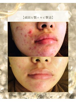 スノースキン(Snow skin)/ニキビケア/ハーブピーリング