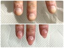 イベント前に深爪ケア