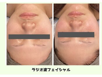 バベルトータルビューティー 北堀江店(Babel Total Beauty)/ラジオ波フェイシャル