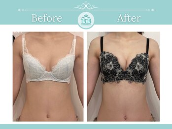 美人バスト アンド ヒップアップ 広島店/バストアップ症例写真