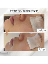 リアン(Lien)/【症例】毛穴ケアコース