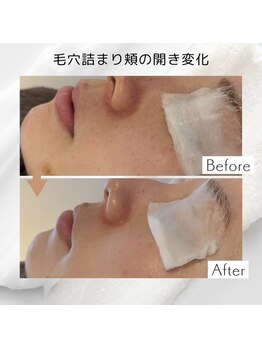 リアン(Lien)/【症例】毛穴ケアコース