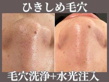 マヴィ 藤井寺店(MavY.)/毛穴洗浄＋水光注入