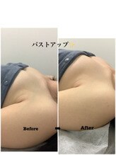 メディカルサロンドオフ 堺東店(medical salon de off)/光バストアップ↑↑ &nbsp;施術前後