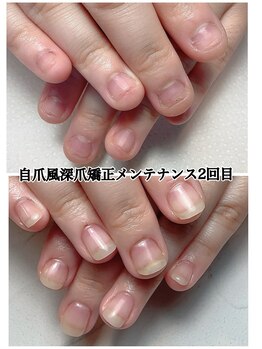 スマイルニコ(smile nico)/深爪も３週間でこの変化