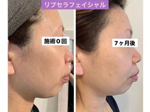 プリュネル(Prunelle)/プラズマシャワー