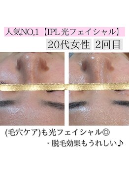 アースコアフュールボーテ ひたち野うしく店(EARTH coiffure beaute)/光フェイシャルで毛穴ケア