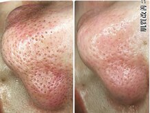 5つ星/◆ハイドロ毛穴洗浄