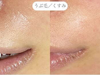 フラックス 京都(FLUX)/【ワックス脱毛】フェイシャル