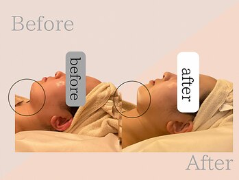 ファミーユ 名古屋店/【術後ケア】顎下吸引後ケア