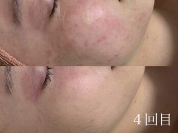 アワピール 天王寺店(AWA PEELL)/ハーブピーリング/ニキビケア