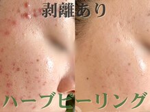 ダリア(Dahlia)の雰囲気（ハーブピーリングで内側から確実な肌質変化を。）