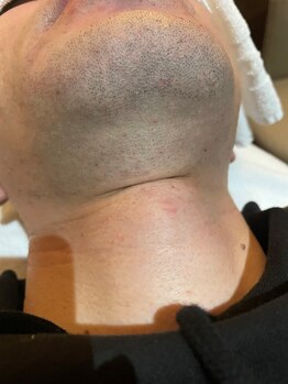 ルーチェ(LUCE)/ひげ脱毛