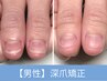【お試し価格】男性●最短120分で見た目が変わる深爪矯正￥31900→
