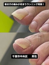 巻き爪じゅん 船橋店/巻き爪改善で再び歩ける足へ