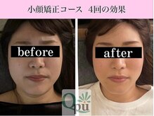 キュープ 福岡大牟田店(Qpu)/小顔矯正4回コースの変化