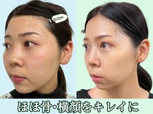 ナチュラルパーフェクトフェイス 新宿/見られるのは横顔/新宿小顔矯正