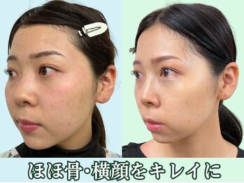 ナチュラルパーフェクトフェイス 新宿/見られるのは横顔/新宿小顔矯正