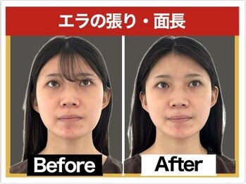 エレヴィザ トウキョウ 恵比寿院(ELVISA TOKYO)/エラの張り・面長が気になる