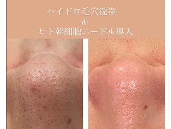 アールグランド 学芸大学店(R-ground)/ハイドロ毛穴洗浄×ヒト幹細胞