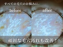 キャロリーヌ 立川店/長年の毛穴悩みが改善
