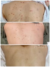 プランス 渋谷(PLANCE)/毛穴/ハーブ/ニキビケア