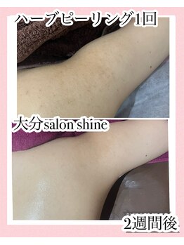 サロンシャイン(Salon Shine)/肩のハーブピーリング1回