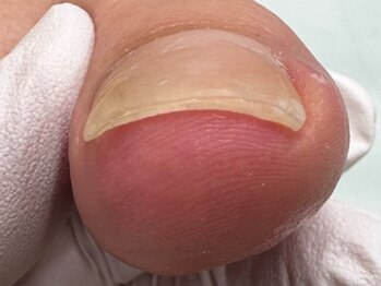 巻き爪補正店 枚方店の写真/巻き爪補正のスペシャリストが長年の爪の悩みを解消！【カウンセリング込☆巻き爪補正1ヶ所￥5,500】